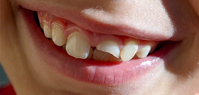 Можно ли наростить сломанный зуб ребенку?